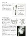 ★理学療法・作業療法実習対策レポート★下肢切断の概要・原因・評価・プログラム・アライメント・断端管理について